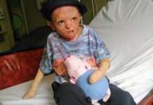 Aarón nos necesita: se incendió su casa en Glew y sufrió quemaduras en el 60 por ciento de su cuerpo