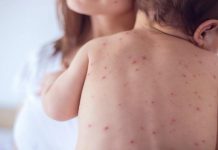 Argentina sufre el peor brote de sarampión en casi 20 años