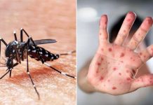 Sarampión y dengue en provincia, medidas y consejos para evitar contagios