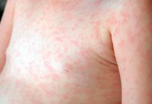 Ya son 144 los casos confirmados de sarampión en el país y crece la preocupación