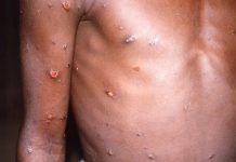 Viruela del mono: cuáles son los síntomas y cómo se contagia