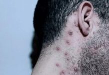 Confirmaron el primer caso de viruela del mono en Mendoza y es el cuarto en todo el país